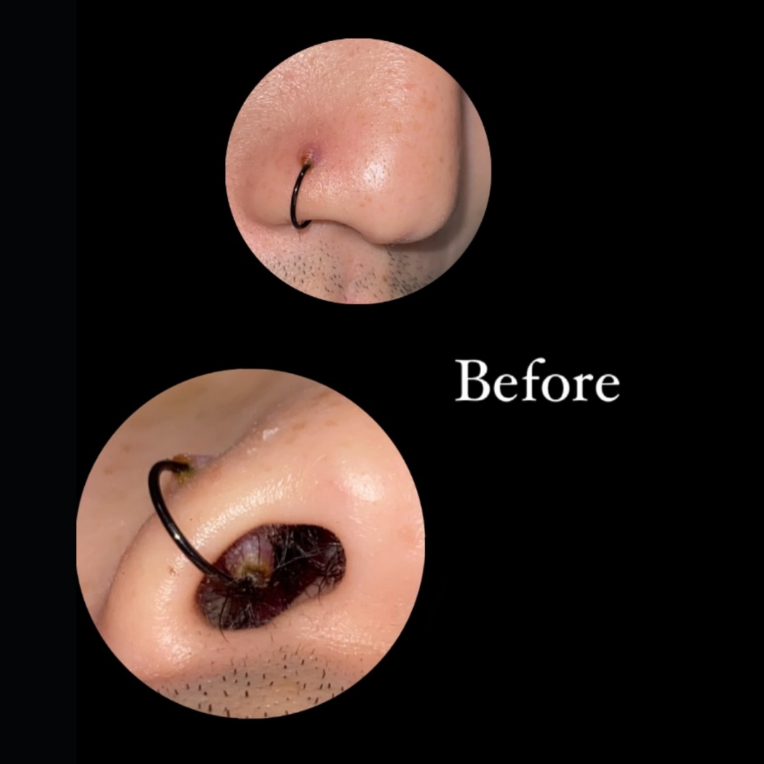 Silicone Discs and Pressure Therapy in Piercing Care