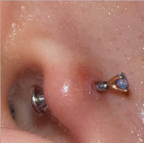 Treat Infection